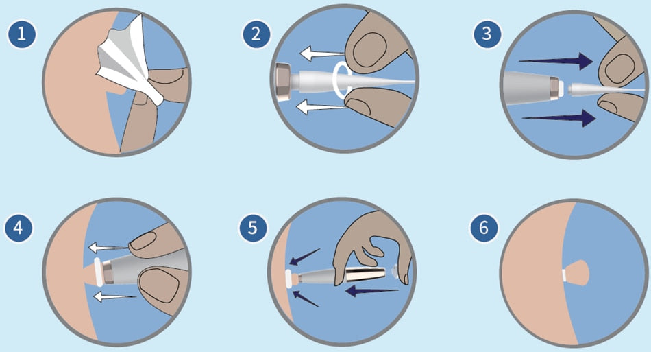 Rapid Tag Removal Kit